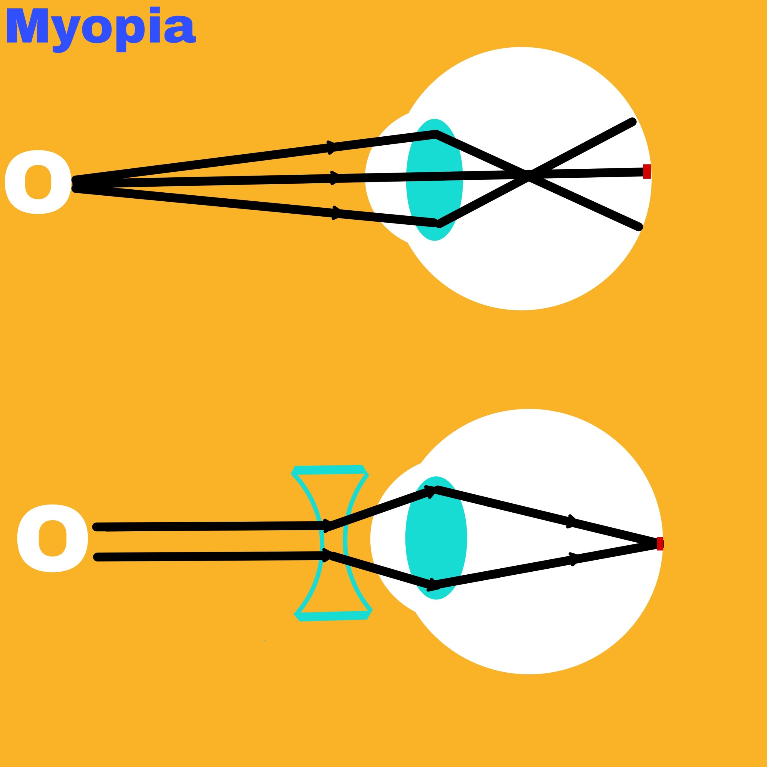 Defects of human eye physics